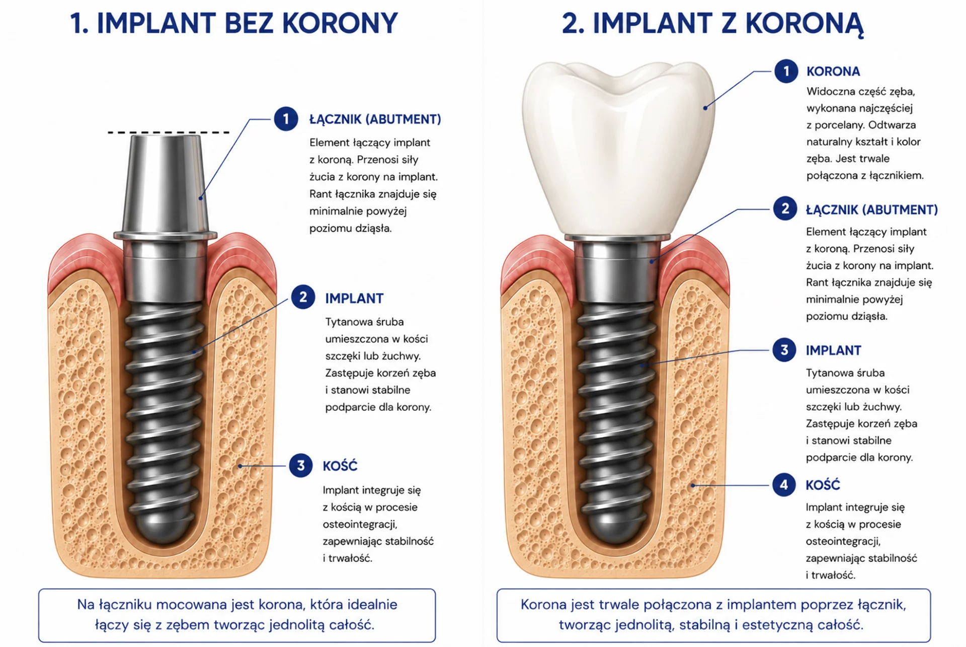 Implant - infografika